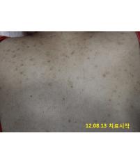 치료 전