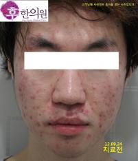 치료 전