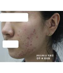 치료 전