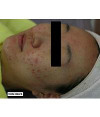 치료 전