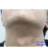 치료 후