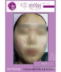 치료 전