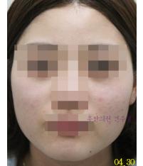치료 후