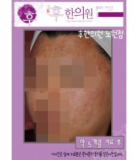치료 후