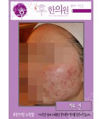 치료 전