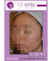 치료 후