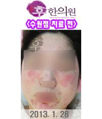 치료 전