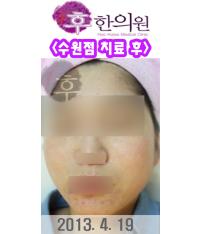 치료 후