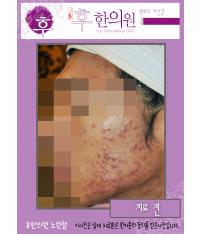 치료 전