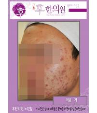 치료 전