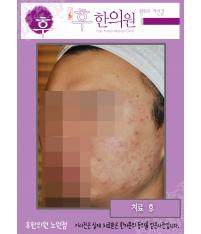 치료 후