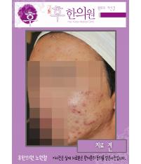 치료 전