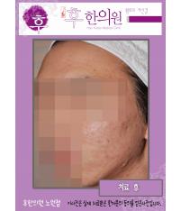 치료 후