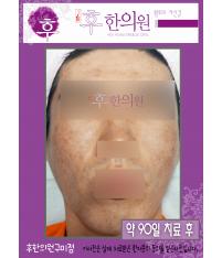 치료 후