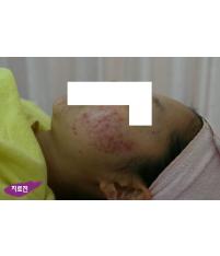 치료 전