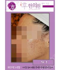 치료 후