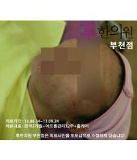 치료 후