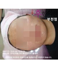 치료 후
