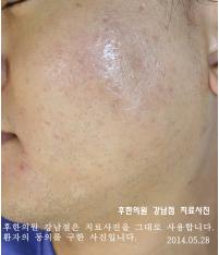 치료 후