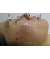 치료 후
