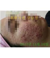 치료 전