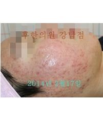 치료 후