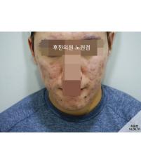 치료 전