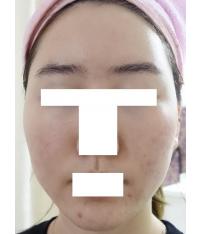 치료 후