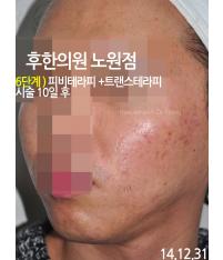 치료 후