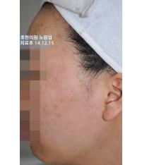 치료 후