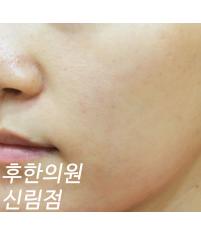 치료 후