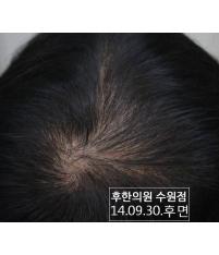 치료 후