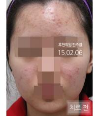 치료 전