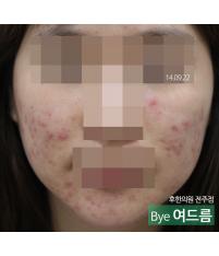 치료 전