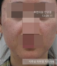 치료 전