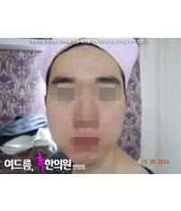 치료 후