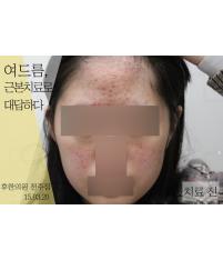 치료 전