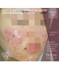 치료 전