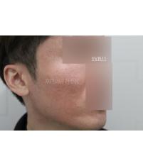 치료 후