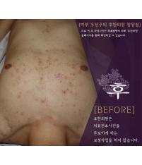 치료 전