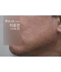 치료 전