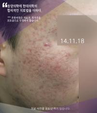 치료 후