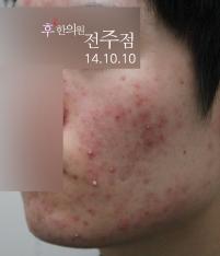 치료 전