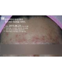 치료 전