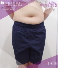 치료 전