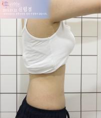 치료 후