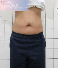 치료 후