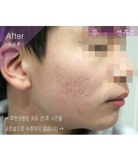 치료 후