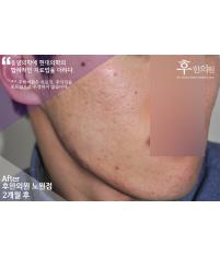 치료 후