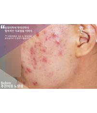 치료 전